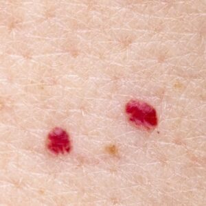 cherry angioma