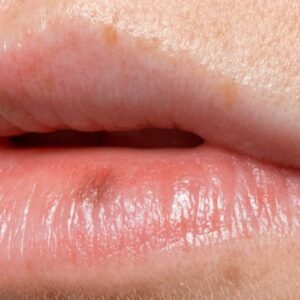 Venous Lakes on Lips