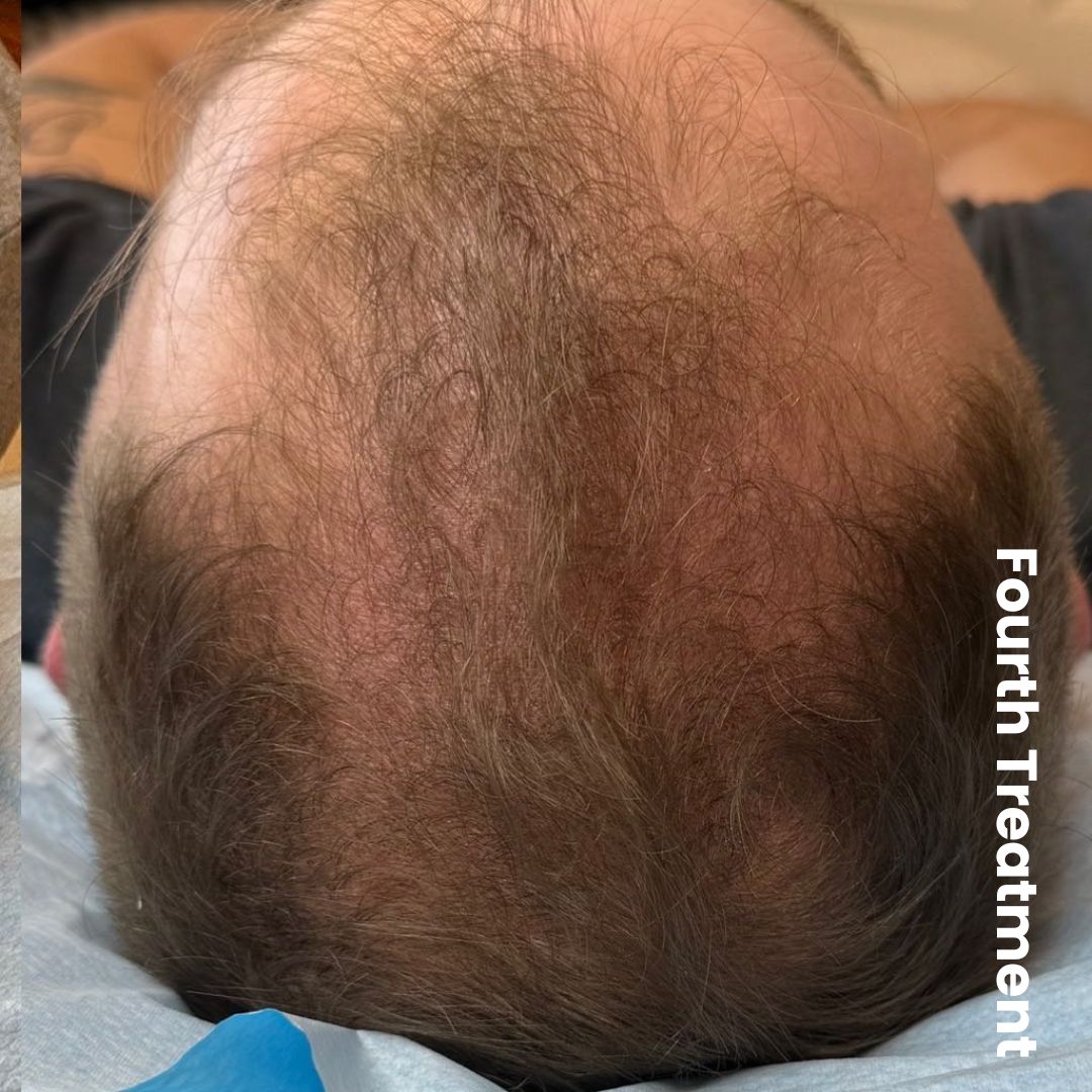 customer testimonial for hair loss treatment in nelson AFTER